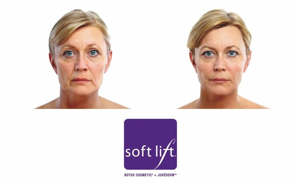 BEFORE and AFTER Soflift™ - photos courtesy of Allergan are provided for informative purposes and are not a guarantee of the result