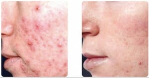 Acne Scar Reduction