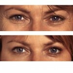 before and after crow's feet Before and After BOTOX® Cosmetic injection for crow's feet - photos courtesy of Allergan Canada