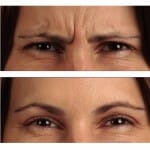 before and fater frown lines Before and After BOTOX® Cosmetic injection for frown lines - photos courtesy of Allergan Canada