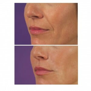 Before and after Juvederm™ - lip enhancement and smile lines, photos courtesy of Allergan Canada