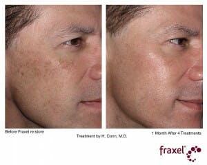 Fraxel Restore