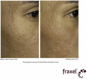 Fraxel Acne Treatment
