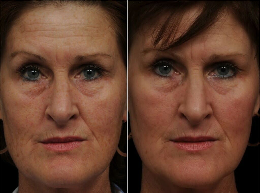AG pre & post 1927 Patient of Dr. Manish Khanna FRCP (C) - Before and after 1 treatment Fraxel® re:store for sun spots/pigmentation