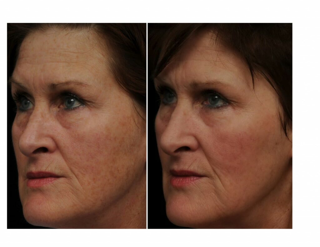 AG pre & post Fraxel 1927 LFT Patient of Dr. Manish Khanna FRCP (C) - Before and after 1 treatment Fraxel® re:store for sun spots/pigmentation CLICK ON IMAGE TO ENLARGE