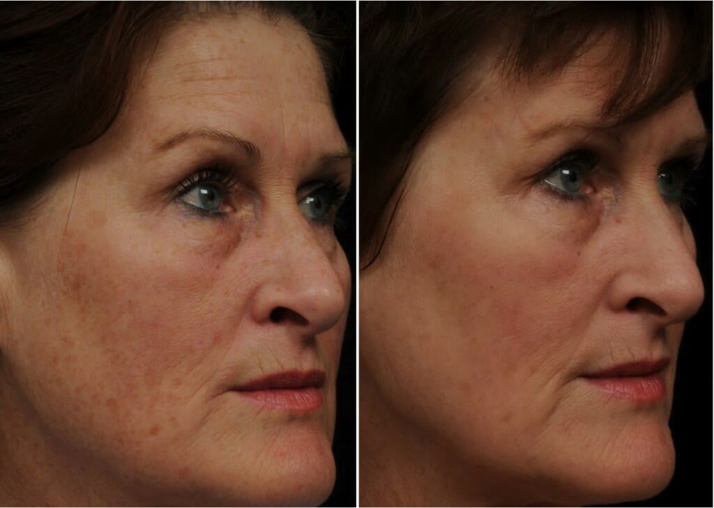 AG pre & post fraxel 1927 RT AG pre & post fraxel 1927 RT