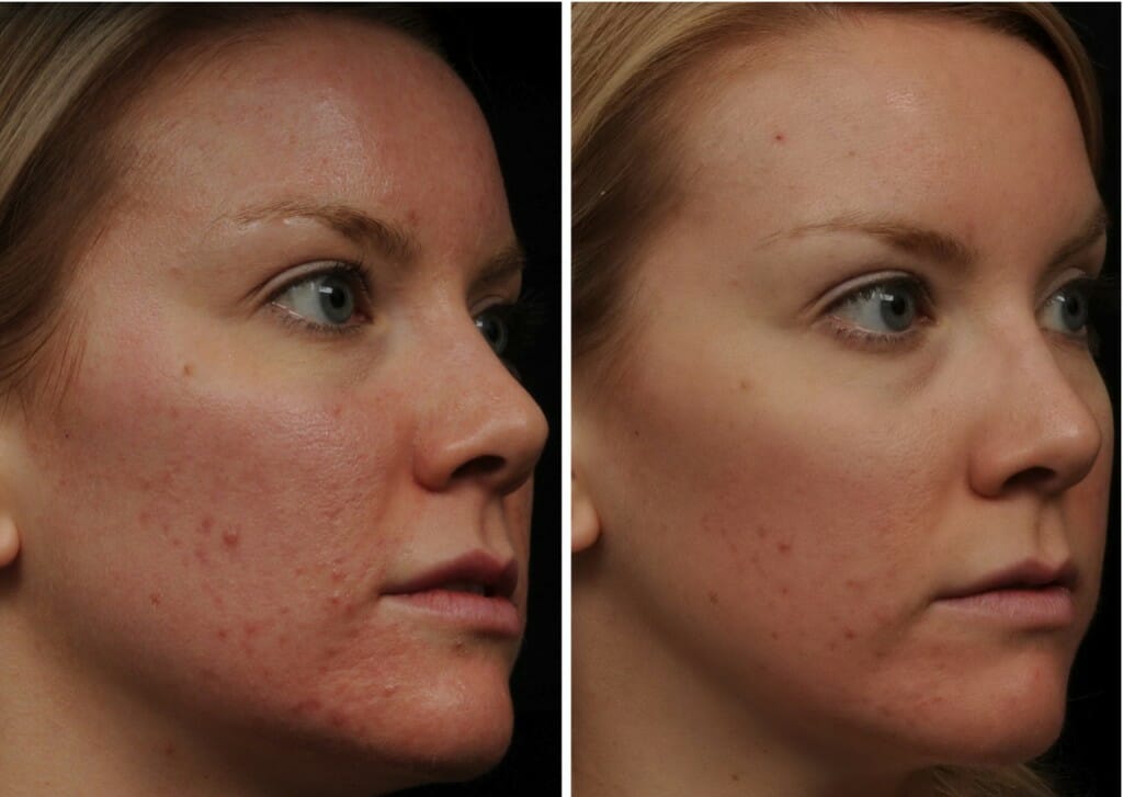 CB pre and post RT Patient of Dr. Manish Khanna FRCP (C) - Before and after 1 treatment Fraxel® re:store for acne scarring CLICK ON IMAGE TO ENLARGE