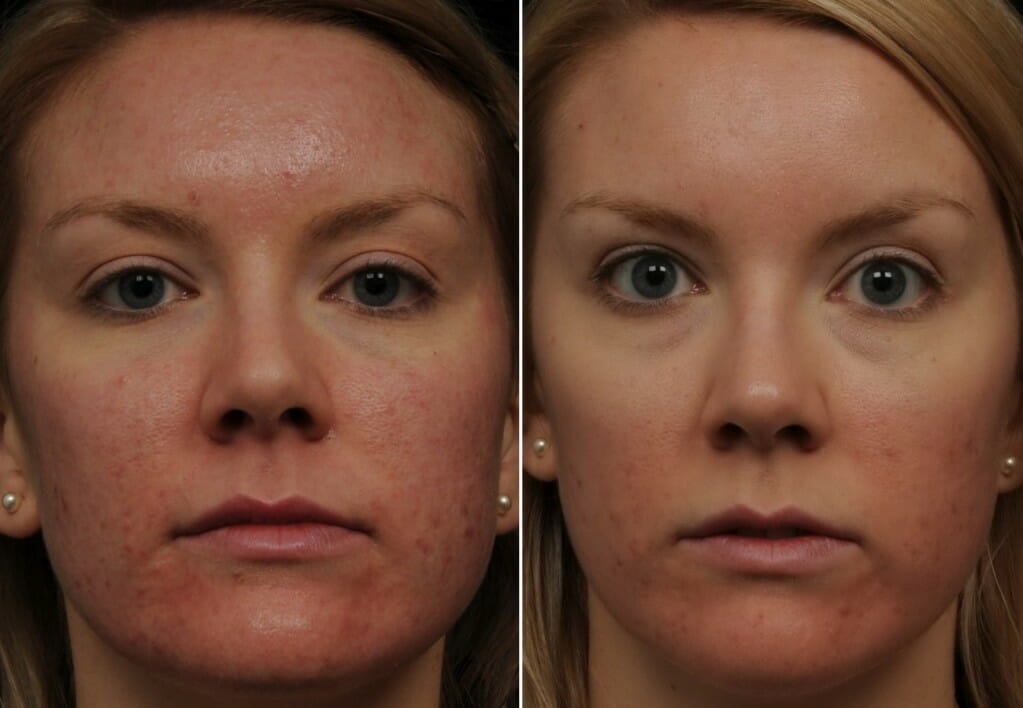 CB pre & post fraxel Patient of Dr. Manish Khanna FRCP (C) - Before and after 1 treatment Fraxel® re:store for acne scarring CLICK ON IMAGE TO ENLARGE