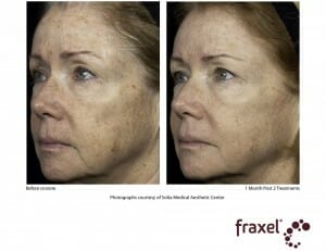 Fraxel_re_store_Dual_Wavelength_Before_and_After_Photo-1L