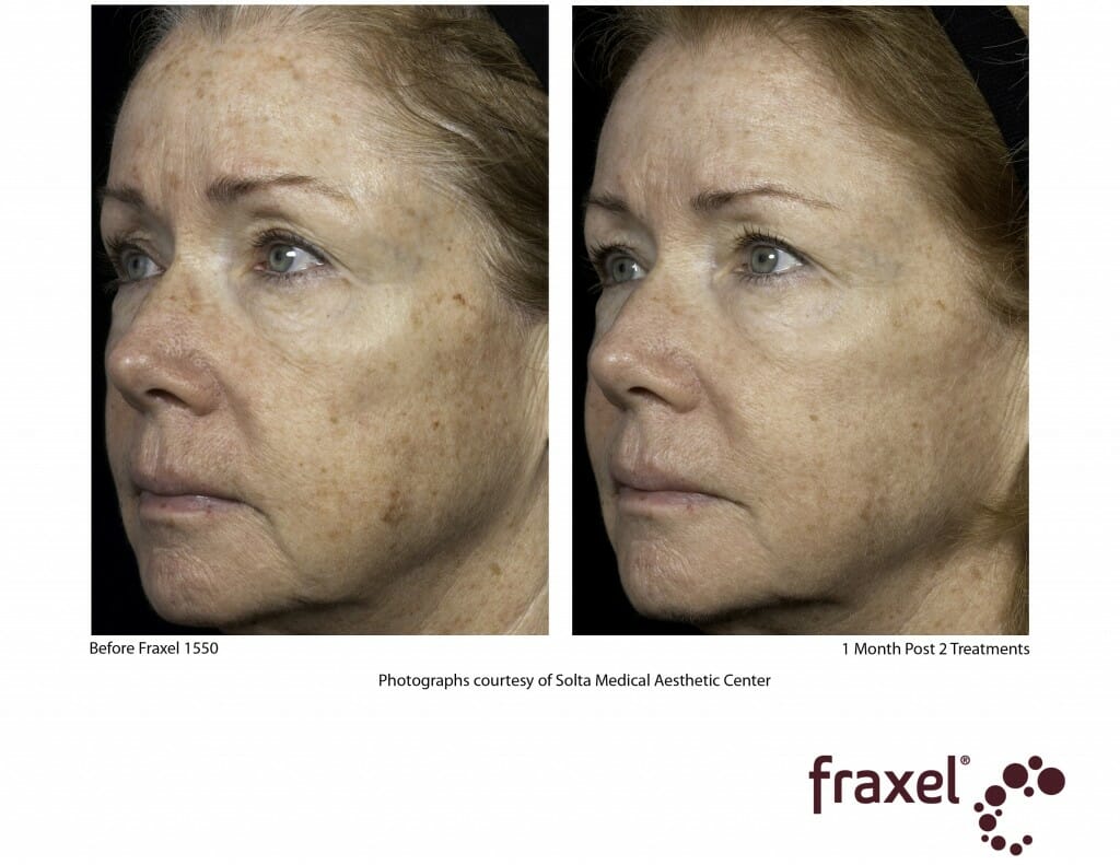 0102-Fraxel_1550_HiRes