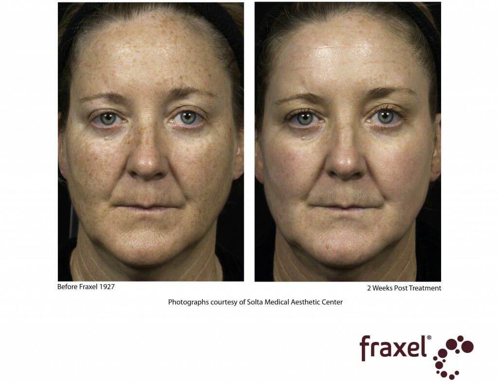 0280-Fraxel_1927_1_HiRes