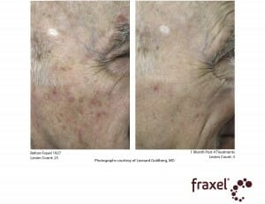 E027-AK-Fraxel_1927_HiRes