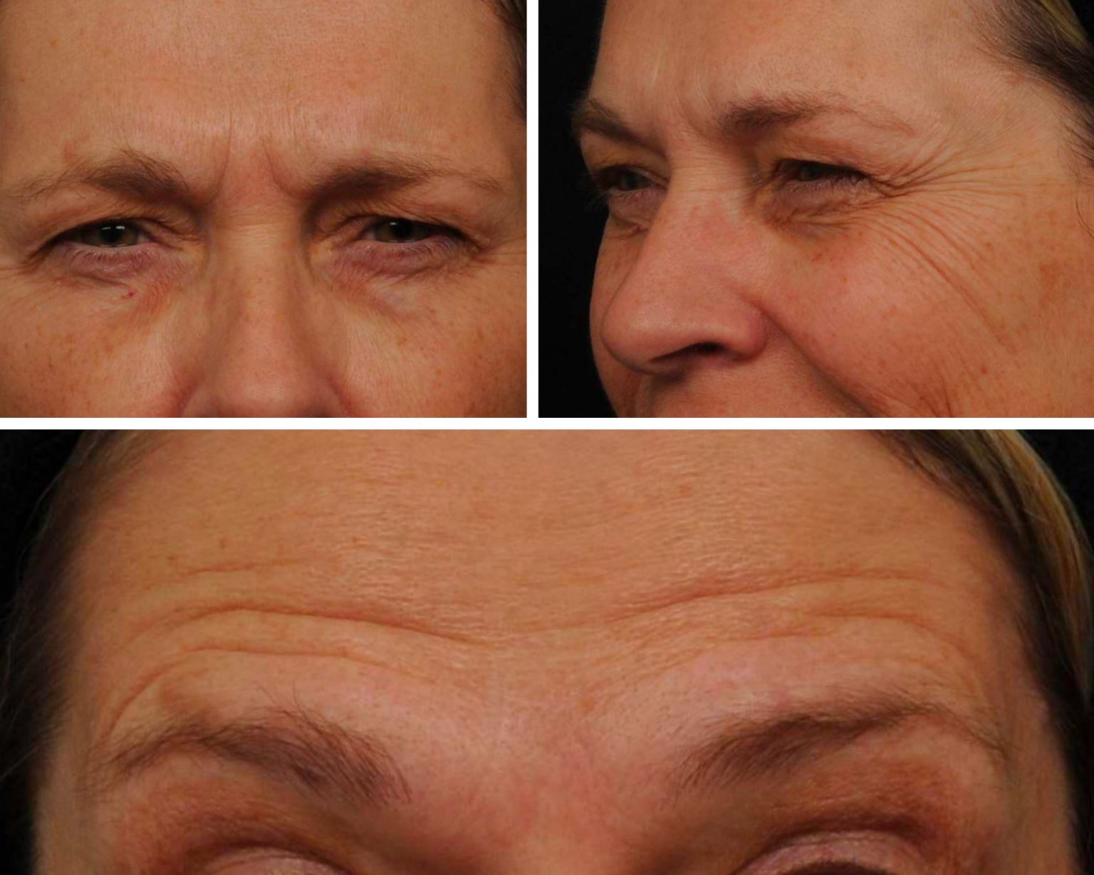 The Top 3 Areas for Botox Injections|Peau Montreal